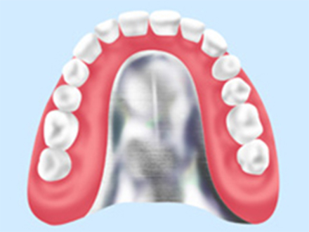 金属床義歯