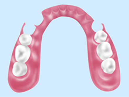 ノンクラスプ義歯