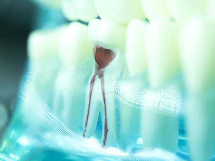 進行した重度の虫歯は「根管治療」を行います