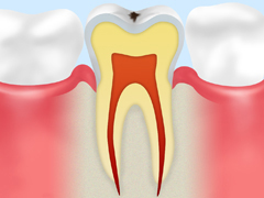 【CO】ごく初期の虫歯
