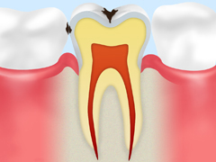【C1】
                                エナメル質の虫歯
                                