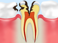 【C2】
                                象牙質の虫歯
                                