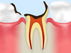 【C3】
                                神経に達した虫歯
                                