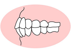 上下顎前突（じょうげがくぜんとつ）