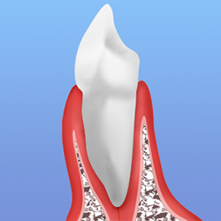 歯周病の進行　
