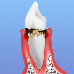 歯周病の進行　