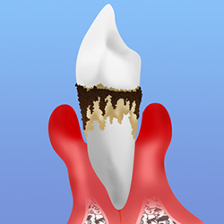 歯周病の進行　