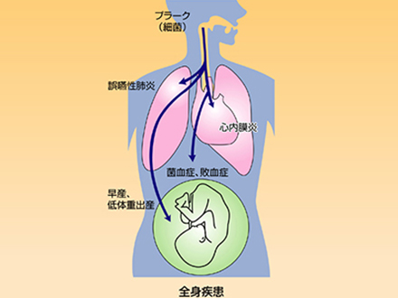 口だけでなく全身に影響をおよぼす歯周病