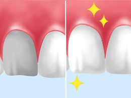 ウォーキングブリーチ